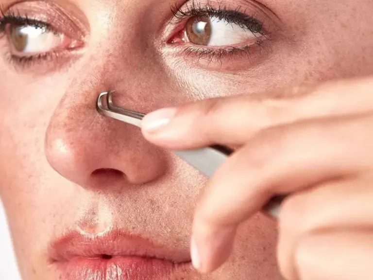 What is best for removing blackheads?